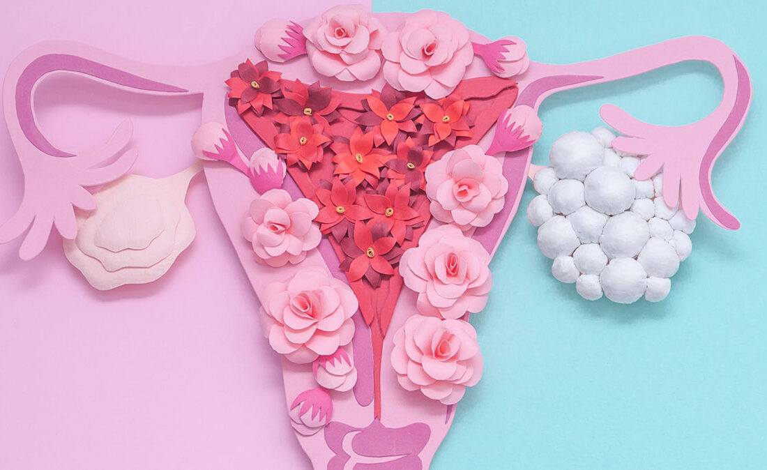 Natural Approaches to PCOS: Managing a Common Hormonal Imbalance – Health Beyond Protocol | Integrative Oncology